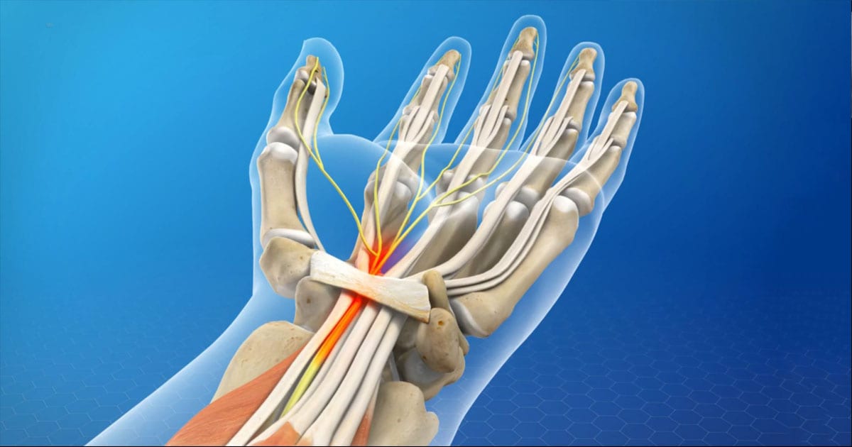 Carpal Tunnel Syndrome Cts Adalah