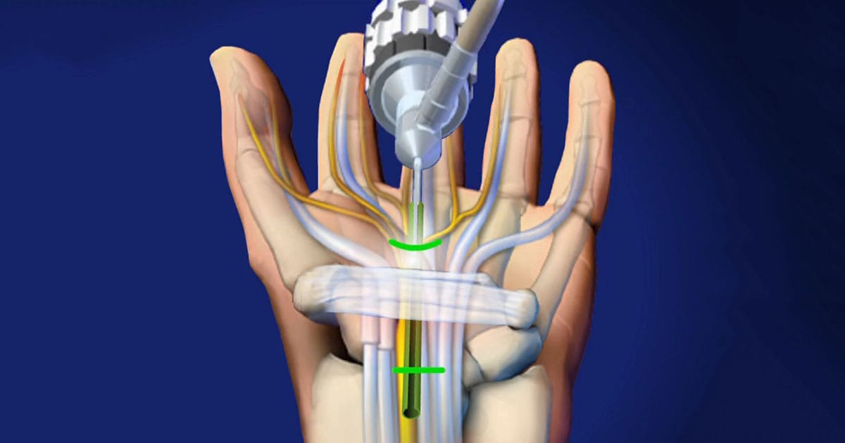 endoscopic hand surgery, endoscopic wrist surgery, and endoscopic elbow surgery