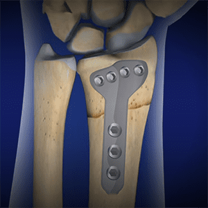 open surgery for wrist fractures