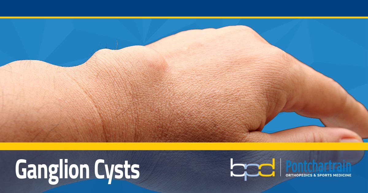 Ganglion Cyst Wrist Images