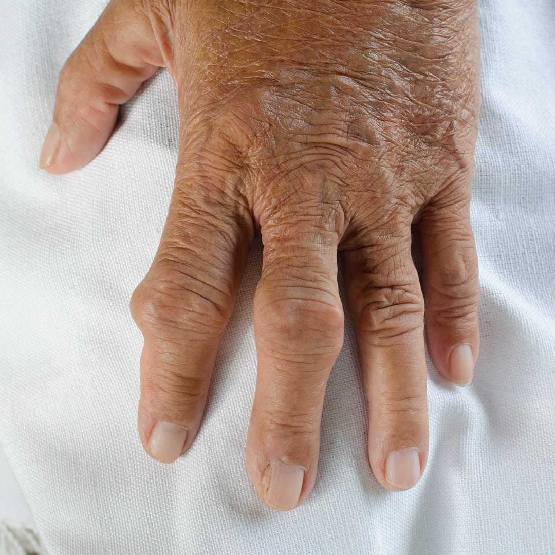Untreated Gout In the Hand