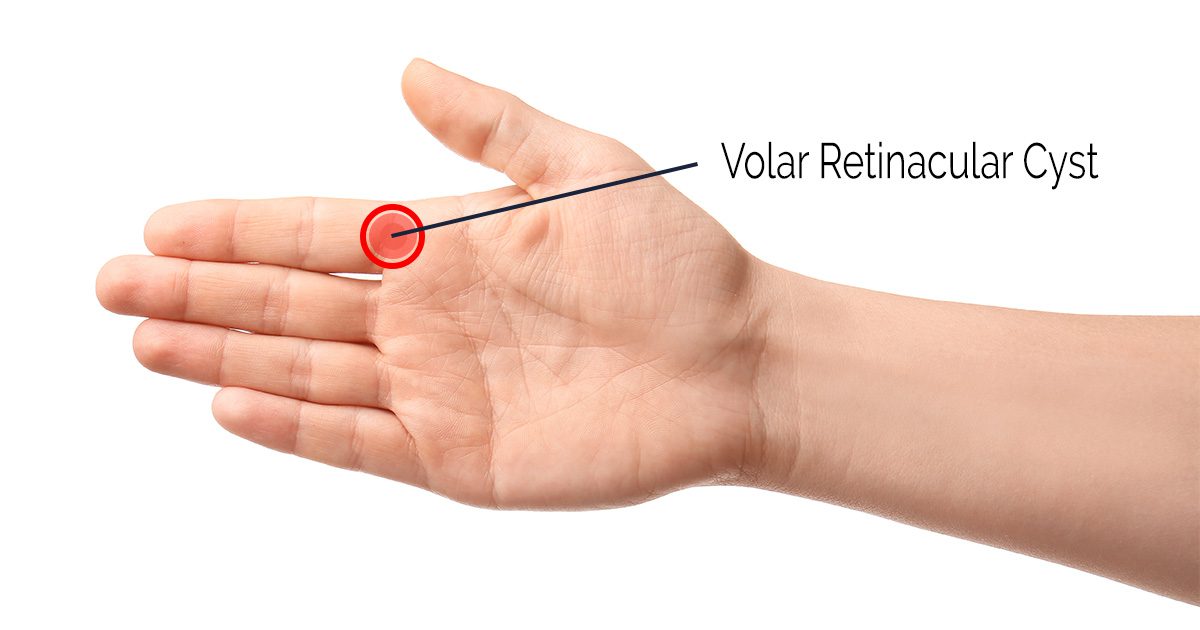 Volar Retinacular Cysts