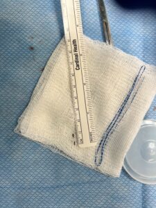 Palm Thorn Hand Injury | Thorn Extracted