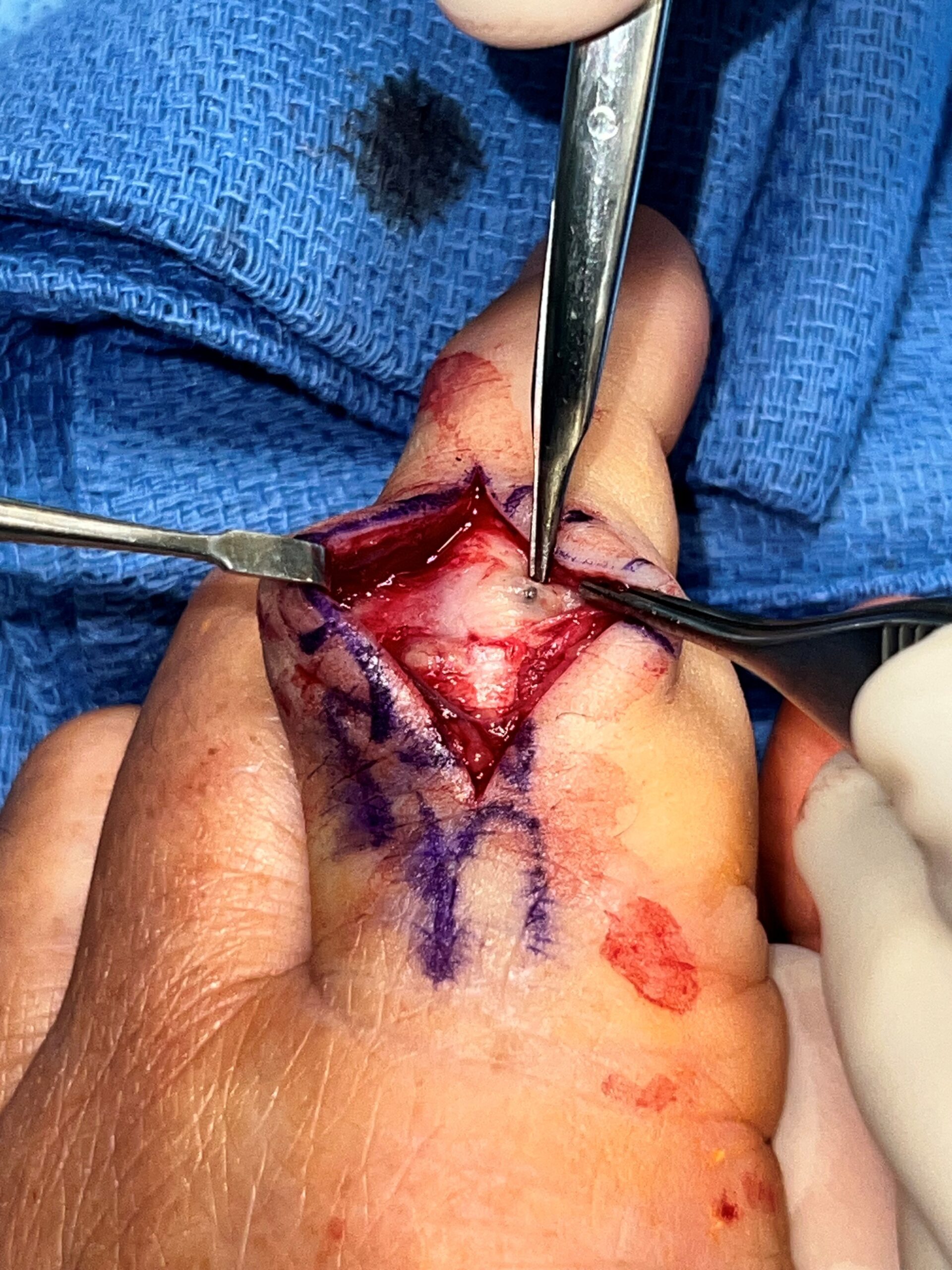 Palm thorn hand injury removal