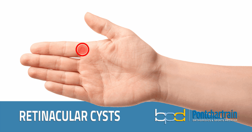 Retinacular Cysts